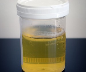 New Urine Test Could Prove Beneficial in Tracking Gluten Free Diet Adherence and Cross-Contamination